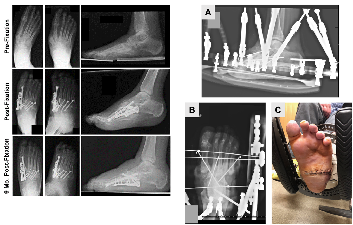 Charcot Neuroarthropathy: Current Concepts | Published in SurgiColl