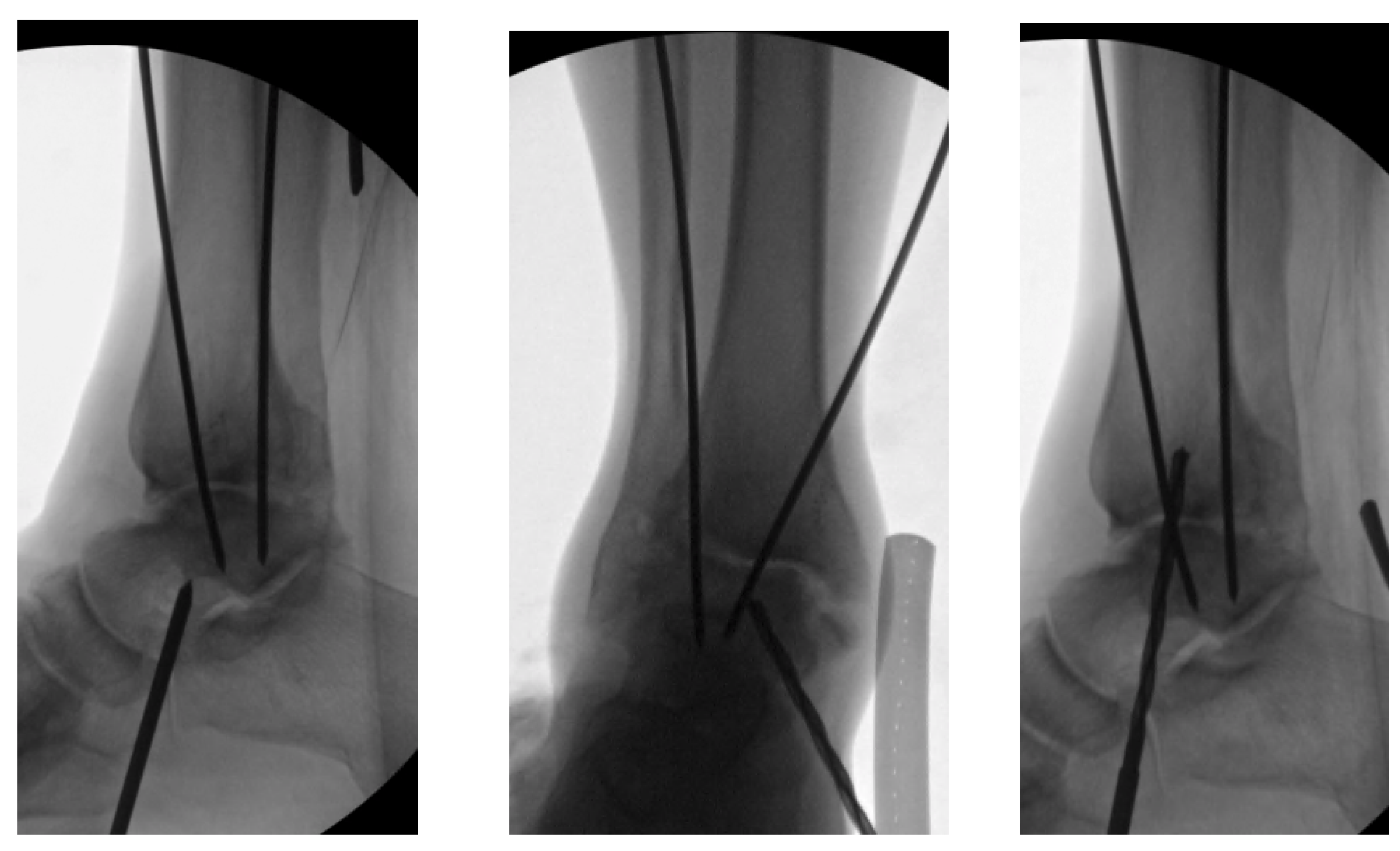 pilot: introduction & distal tibial fractures - Orthohub