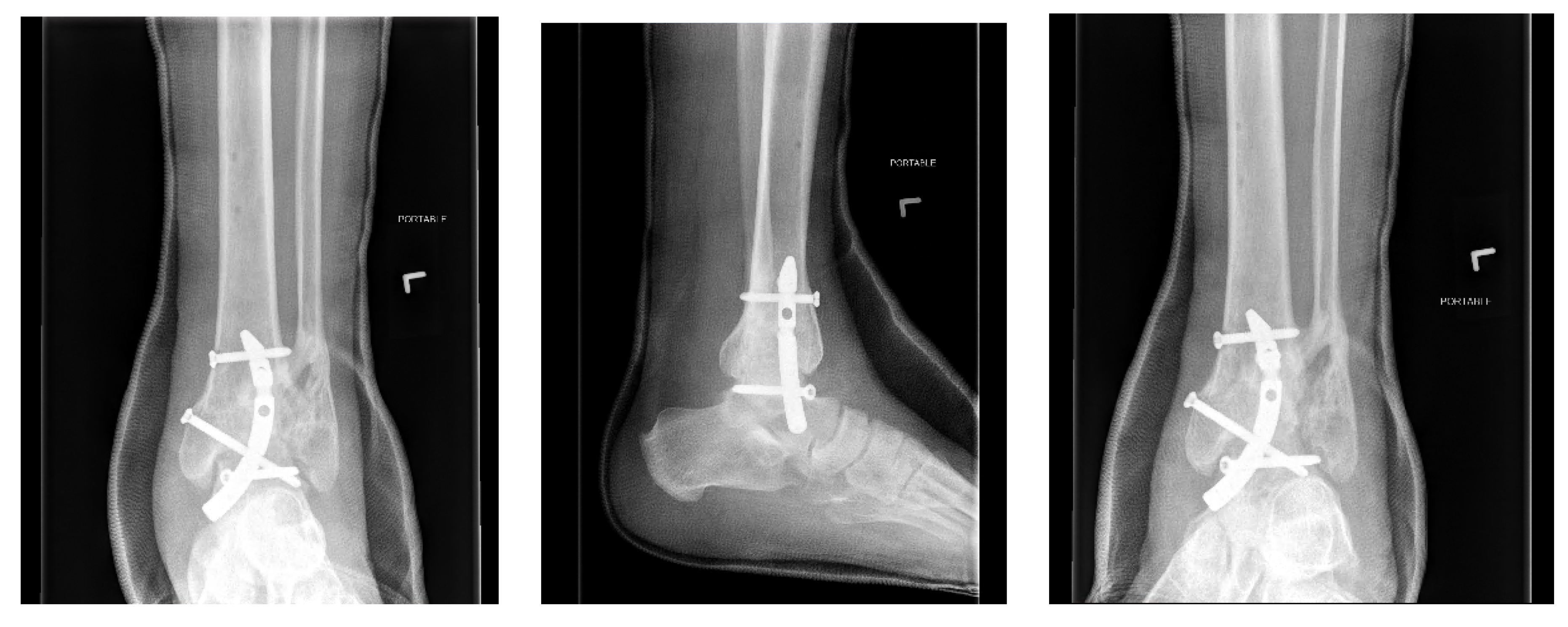 A) Preoperative radiographs of a subluxation trimalleolar ankle... |  Download Scientific Diagram