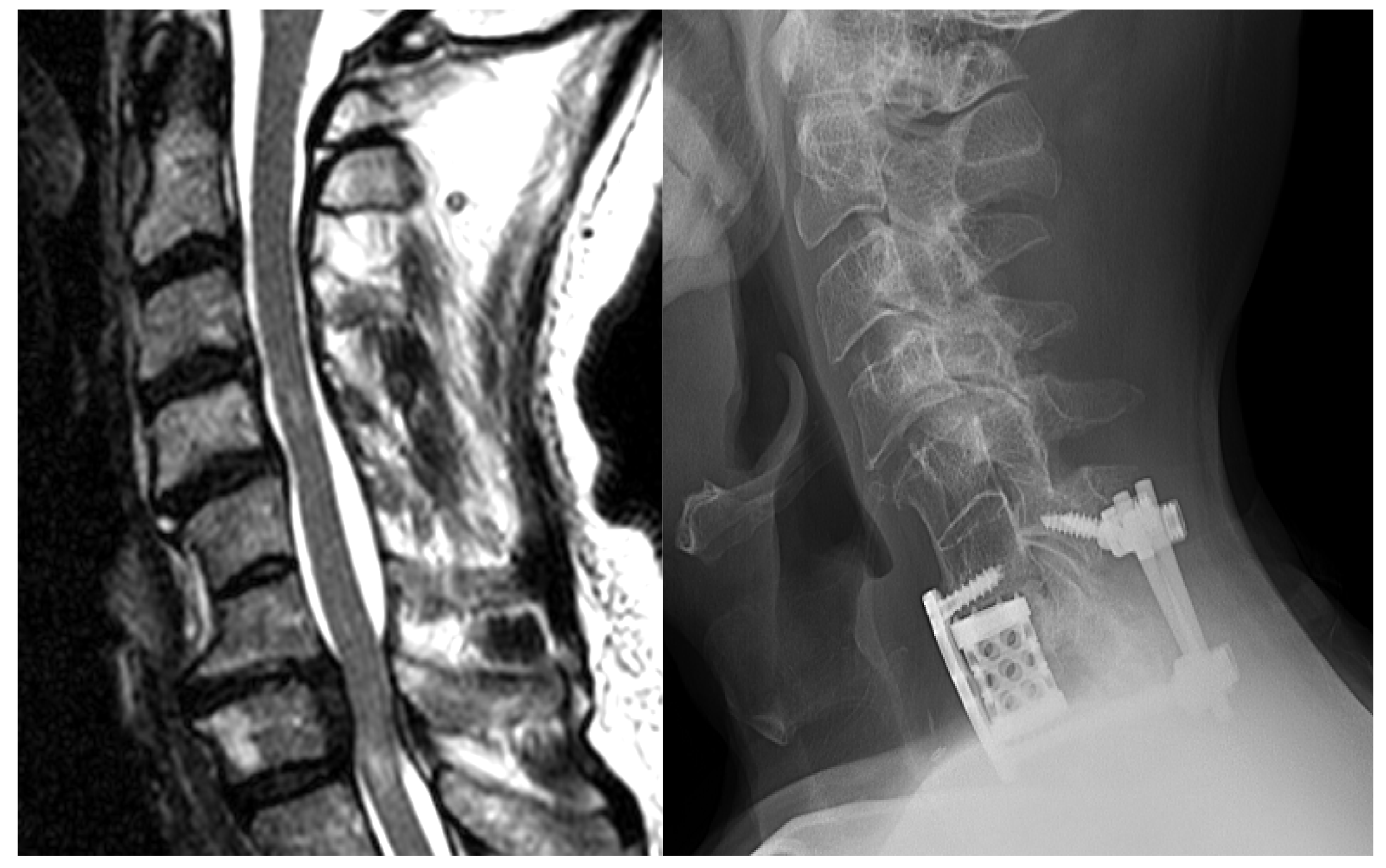Cervical Myelopathy Diagnosis And Surgical Strategies Published In 