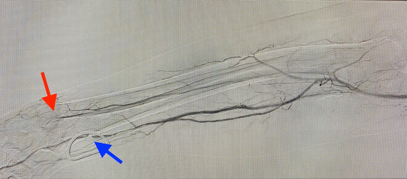 Below Elbow Amputation Due To Ischemic Complications After Radial